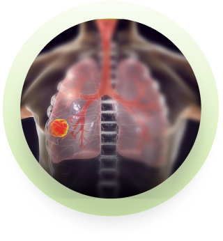 Lung abscess