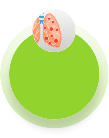 Emphysema